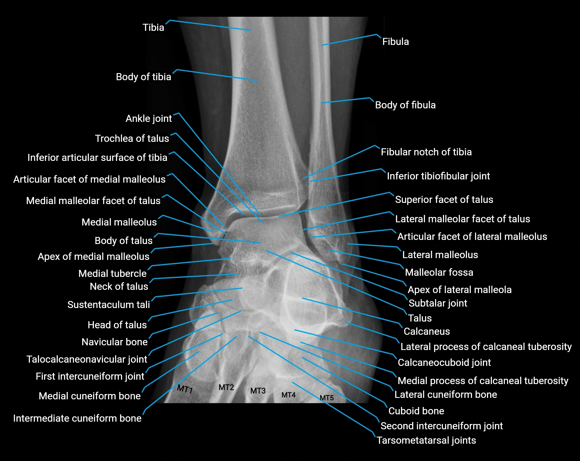 X Ray ankle AP anatomy.webp